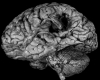 Cavitated infarct, posterior middle cerebral artery circulation